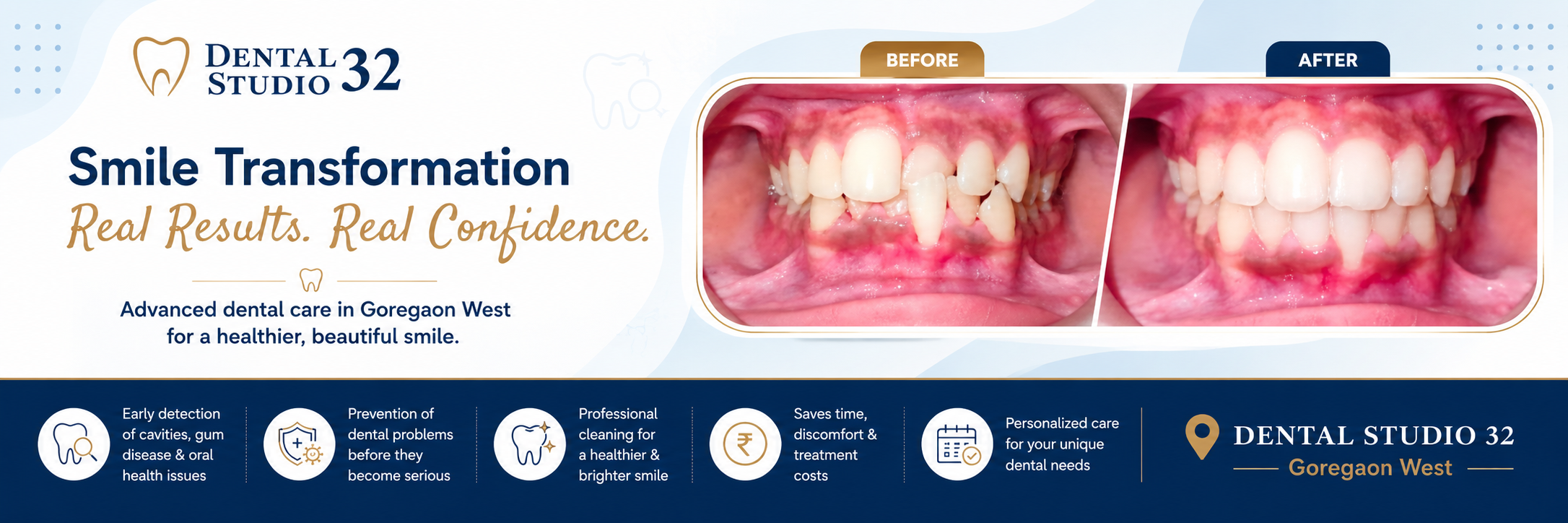 Smile transformation case study result at Dental Studio 32 Goregaon West