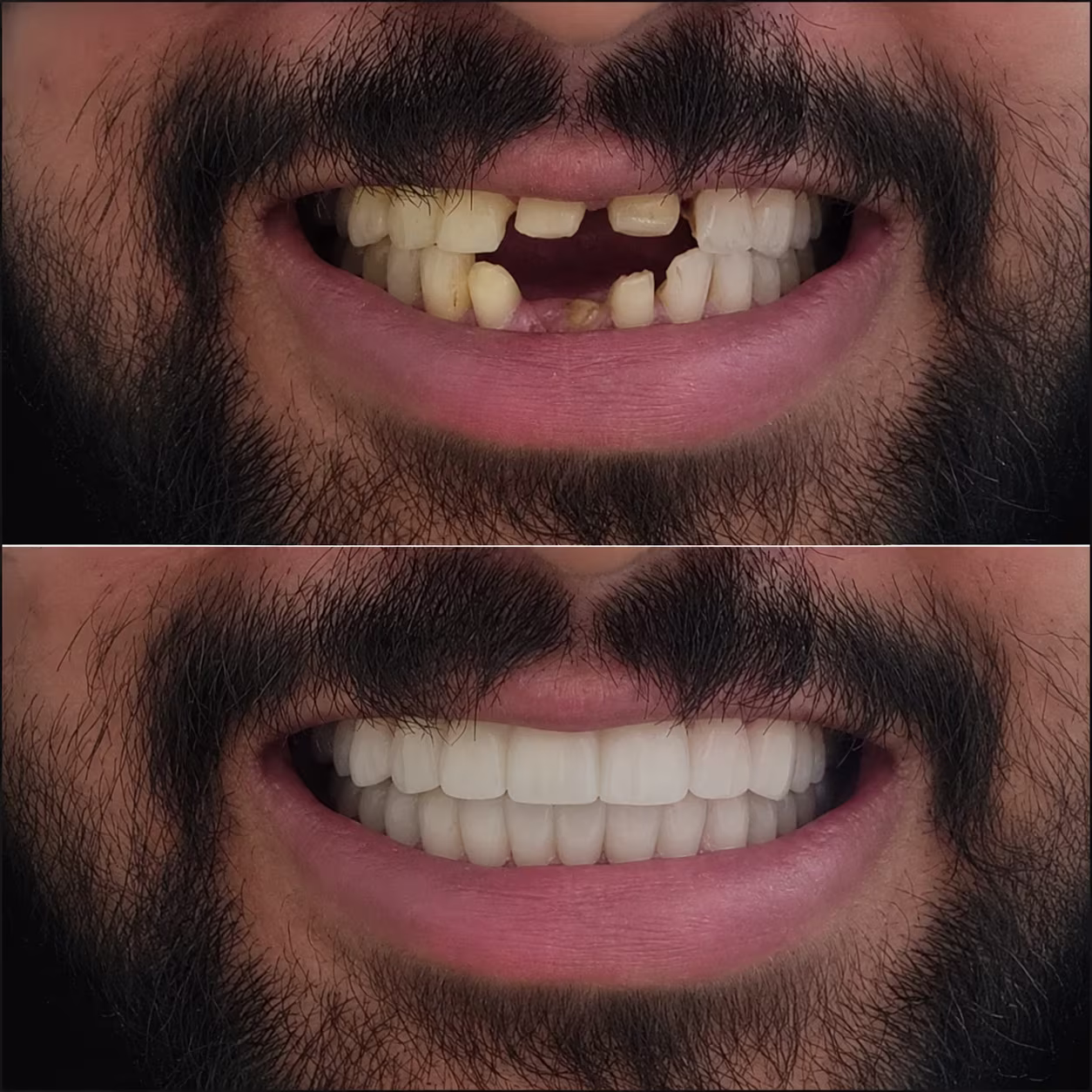 Before and after smile transformation result at Dental Studio 32 Goregaon West
